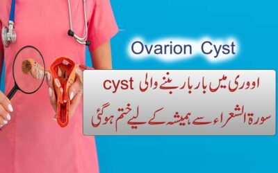 Cyst Se Shifa Ka Naqsh